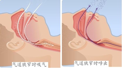 气道狭窄对呼吸的影响