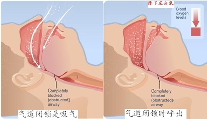 气道闭锁时的呼吸